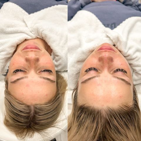 Chemical Peel for Acne